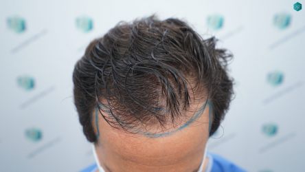 Injerto Capilar Técnica FUE Grafts 3060 (6835 Pelos) 11 12A DISENO LINEA DE INJERTO