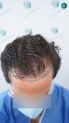 Injerto Capilar Técnica FUE Grafts 3060 (6835 Pelos) 12 13 DISENO LINEA DE INJERTO 1