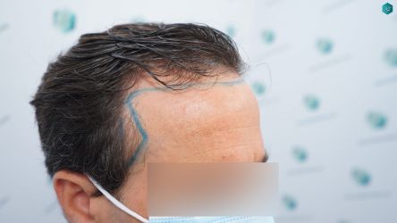 Injerto Capilar Técnica FUE Grafts 3060 (6835 Pelos) 13 13A DISENO LINEA DE INJERTO