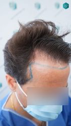 Injerto Capilar Técnica FUE Grafts 3060 (6835 Pelos) 14 14 DISENO LINEA DE INJERTO 1