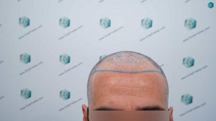 Injerto Capilar Técnica FUE Grafts 2519 (5393 Pelos) 15 14 DISENO LINEA DE INJERTO