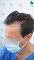 Injerto Capilar Técnica FUE Grafts 3060 (6835 Pelos) 16 16 DISENO LINEA DE INJERTO 1
