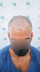 Injerto Capilar Técnica FUE Grafts 2519 (5393 Pelos) 17 16 DISENO LINEA DE INJERTO