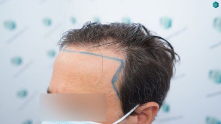 Injerto Capilar Técnica FUE Grafts 3060 (6835 Pelos) 17 17 DISENO LINEA DE INJERTO 1