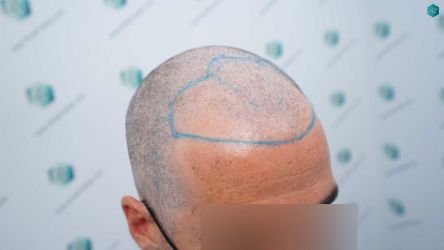 Injerto Capilar Técnica FUE Grafts 2519 (5393 Pelos) 18 17 DISENO LINEA DE INJERTO