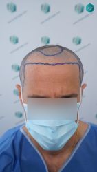 Injerto Capilar Técnica FUE Grafts 3060 (6835 Pelos) 18 17A DISENO LINEA DE INJERTO 1