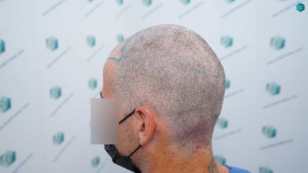Injerto Capilar Técnica FUE Grafts 2519 (5393 Pelos) 20 17B DISENO LINEA DE INJERTO