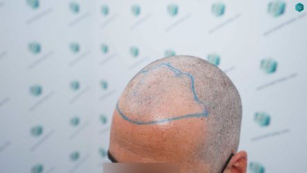 Injerto Capilar Técnica FUE Grafts 2519 (5393 Pelos) 21 18 DISENO LINEA DE INJERTO