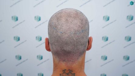 Injerto Capilar Técnica FUE Grafts 2519 (5393 Pelos) 22 19 DISENO LINEA DE INJERTO