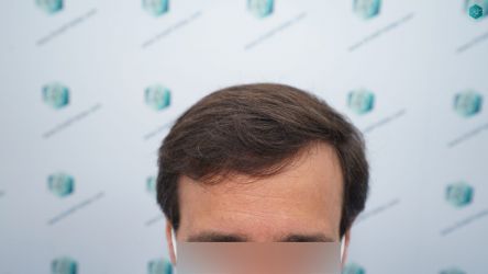 Injerto Capilar Técnica FUE Grafts 3060 (6835 Pelos) 1 2 ANTES DEL TRASPLANTE CAPILAR 1