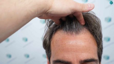 Injerto Capilar Técnica FUE Grafts 2519 (5393 Pelos) 2 2 ANTES DEL TRASPLANTE CAPILAR