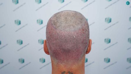 Injerto Capilar Técnica FUE Grafts 2519 (5393 Pelos) 24 23 TRASPLANTE CAPILAR.