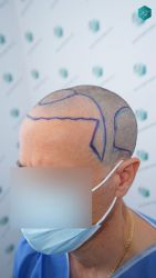 Injerto Capilar Técnica FUE Grafts 3060 (6835 Pelos) 24 24 DISENO LINEA DE INJERTO