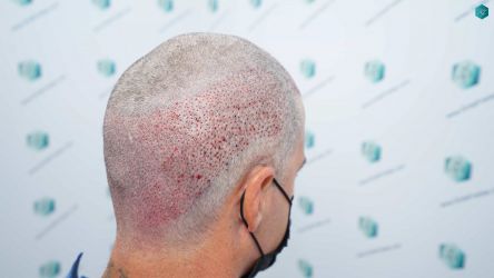 Injerto Capilar Técnica FUE Grafts 2519 (5393 Pelos) 25 24 TRASPLANTE CAPILAR.