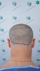 Injerto Capilar Técnica FUE Grafts 3060 (6835 Pelos) 25 25 DISENO LINEA DE INJERTO