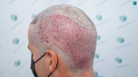 Injerto Capilar Técnica FUE Grafts 2519 (5393 Pelos) 26 25 TRASPLANTE CAPILAR.