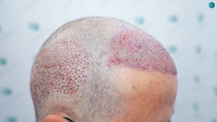 Injerto Capilar Técnica FUE Grafts 2519 (5393 Pelos) 27 26 TRASPLANTE CAPILAR.
