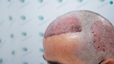 Injerto Capilar Técnica FUE Grafts 2519 (5393 Pelos) 28 27 TRASPLANTE CAPILAR.