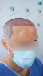 Injerto Capilar Técnica FUE Grafts 3060 (6835 Pelos) 26 28 TRASPLANTE CAPILAR