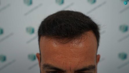 28A RESULTADOS A LOS 12 MESES