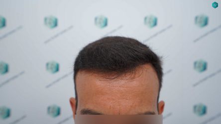 28B RESULTADOS A LOS 12 MESES
