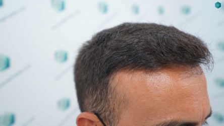 29 RESULTADOS A LOS 12 MESES