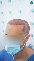 Injerto Capilar Técnica FUE Grafts 3060 (6835 Pelos) 27 29 TRASPLANTE CAPILAR