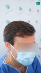 Injerto Capilar Técnica FUE Grafts 3060 (6835 Pelos) 2 3 ANTES DEL TRASPLANTE CAPILAR 1