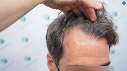 Injerto Capilar Técnica FUE Grafts 2519 (5393 Pelos) 3 3 ANTES DEL TRASPLANTE CAPILAR