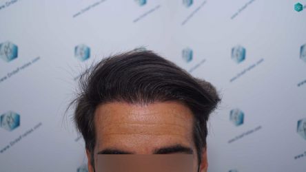 Injerto Capilar Técnica FUE Grafts 2519 (5393 Pelos) 30 30 RESULTADOS 12 MESES