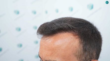 30 RESULTADOS A LOS 12 MESES