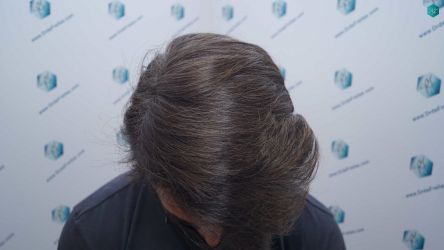 Injerto Capilar Técnica FUE Grafts 2519 (5393 Pelos) 31 31 RESULTADOS 12 MESES