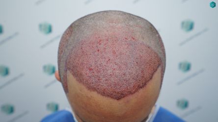Injerto Capilar Técnica FUE Grafts 3060 (6835 Pelos) 28 31 TRASPLANTE CAPILAR
