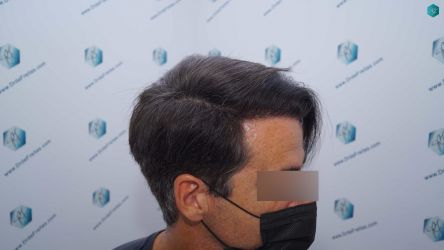 Injerto Capilar Técnica FUE Grafts 2519 (5393 Pelos) 32 31A En 12 meses