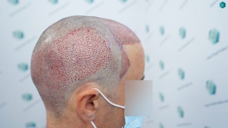 Injerto Capilar Técnica FUE Grafts 3060 (6835 Pelos) 29 32 TRASPLANTE CAPILAR