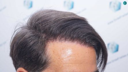 Injerto Capilar Técnica FUE Grafts 2519 (5393 Pelos) 33 32B RESULTADOS 12 MESES