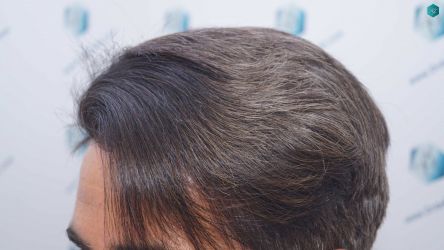 Injerto Capilar Técnica FUE Grafts 2519 (5393 Pelos) 34 33 RESULTADOS 12 MESES