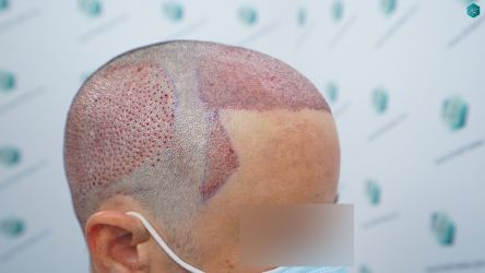 Injerto Capilar Técnica FUE Grafts 3060 (6835 Pelos) 30 33 TRASPLANTE CAPILAR