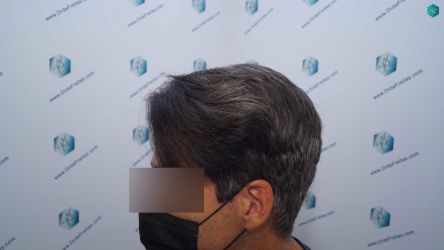Injerto Capilar Técnica FUE Grafts 2519 (5393 Pelos) 35 33A RESULTADOS 12 MESES