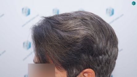 Injerto Capilar Técnica FUE Grafts 2519 (5393 Pelos) 36 33B RESULTADOS 12 MESES