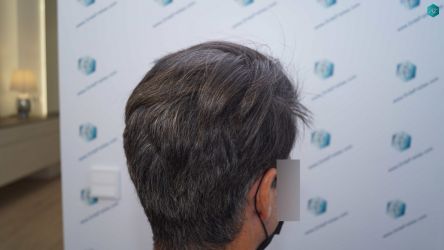 Injerto Capilar Técnica FUE Grafts 2519 (5393 Pelos) 37 34 RESULTADOS 12 MESES