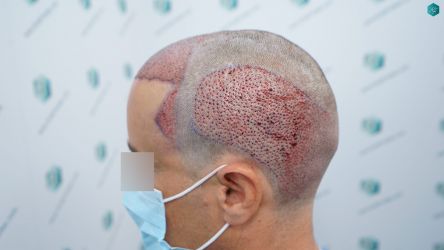Injerto Capilar Técnica FUE Grafts 3060 (6835 Pelos) 31 34 TRASPLANTE CAPILAR