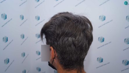 Injerto Capilar Técnica FUE Grafts 2519 (5393 Pelos) 38 35 RESULTADOS 12 MESES