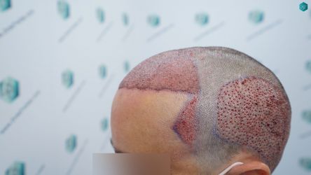 Injerto Capilar Técnica FUE Grafts 3060 (6835 Pelos) 32 35 TRASPLANTE CAPILAR