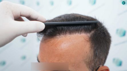 36 RESULTADOS A LOS 12 MESES