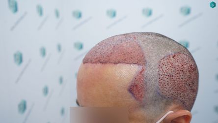 Injerto Capilar Técnica FUE Grafts 3060 (6835 Pelos) 33 36 TRASPLANTE CAPILAR