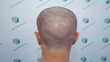Injerto Capilar Técnica FUE Grafts 3060 (6835 Pelos) 34 37 TRASPLANTE CAPILAR