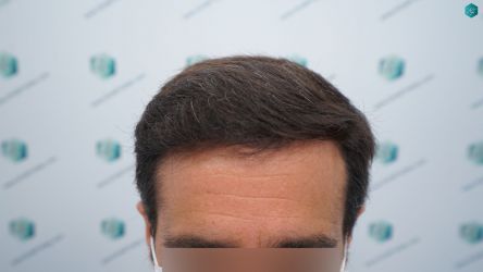 Injerto Capilar Técnica FUE Grafts 3060 (6835 Pelos) 35 39 RESULTADOS A LOS 12 MESES