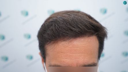 Injerto Capilar Técnica FUE Grafts 3060 (6835 Pelos) 36 39A RESULTADOS A LOS 12 MESES