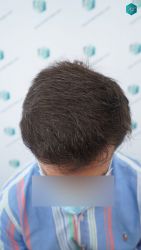 Injerto Capilar Técnica FUE Grafts 3060 (6835 Pelos) 37 39B RESULTADOS A LOS 12 MESES